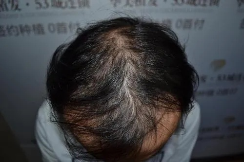 脱发兰州哪个医院好啊的相关长尾关键词有哪些 脱发兰州哪个医院好啊的相关长尾关键词有哪些