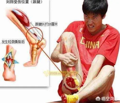跟腱断裂的后果有多严重?年轻人必须警惕的运动伤害 跟腱断裂的后果有多严重?年轻人必须警惕的运动伤害