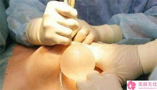 丰胸手术杭州的相关长尾关键词有哪些 丰胸手术杭州的相关长尾关键词有哪些