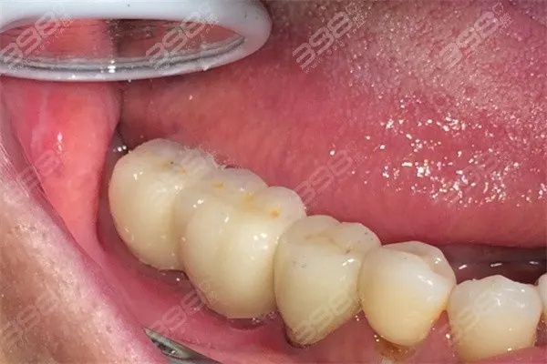 牙齿疼想拔牙兰州哪里的牙科看的好? 牙齿疼想拔牙兰州哪里的牙科看的好?