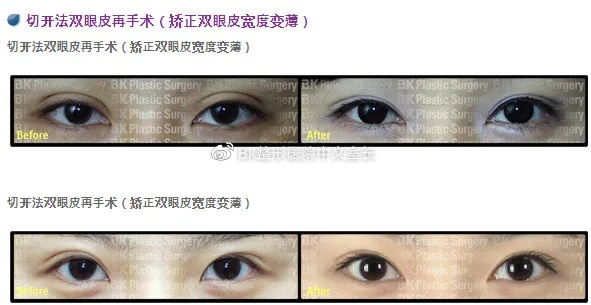 合肥汪凯双眼皮案例相关长尾关键词有哪些 合肥汪凯双眼皮案例相关长尾关键词有哪些