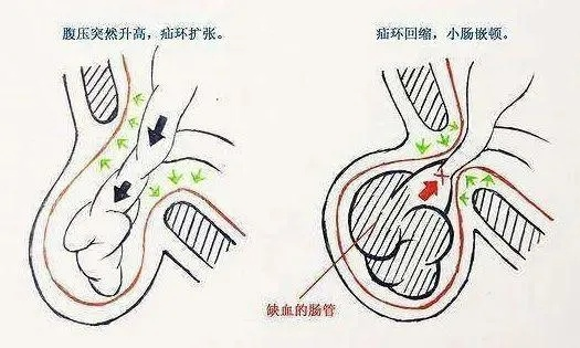 从巅峰到低谷:我的运动型疝气噩梦与重生之路 从巅峰到低谷:我的运动型疝气噩梦与重生之路