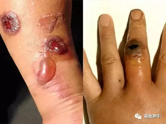 辽宁炭疽疫情:一位亲历者的真实讲述与内心独白 辽宁炭疽疫情:一位亲历者的真实讲述与内心独白