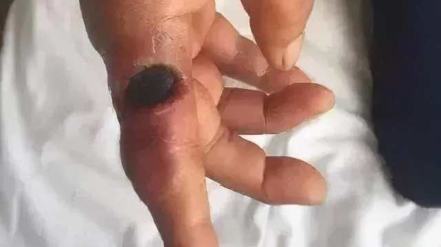 辽宁炭疽疫情:一位亲历者的真实讲述与内心独白 辽宁炭疽疫情:一位亲历者的真实讲述与内心独白