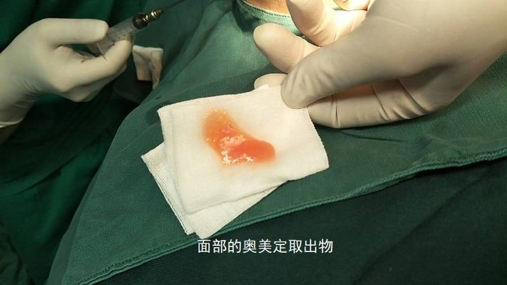 大连奥美定取出的长尾关键词有什么 大连奥美定取出的长尾关键词有什么