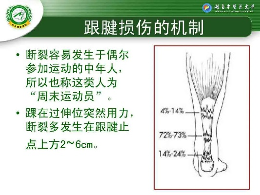 跟腱撕裂:原因、症状与康复全解析 跟腱撕裂:原因、症状与康复全解析