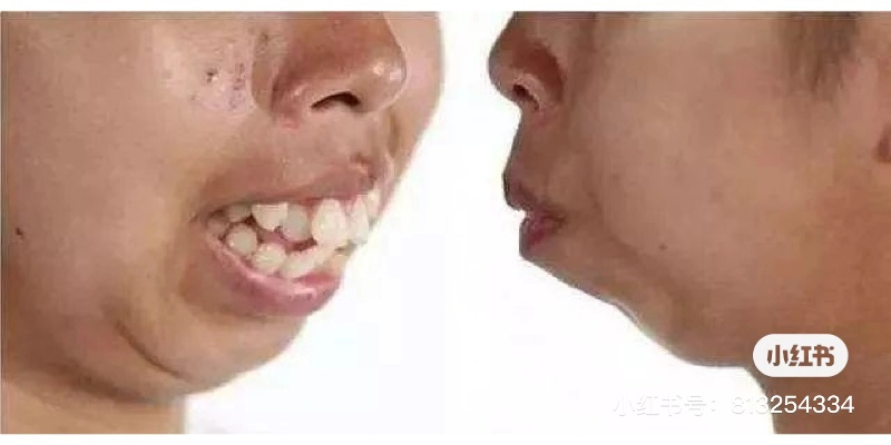 桂林龅牙纠正的相关长尾关键词有哪些 桂林龅牙纠正的相关长尾关键词有哪些